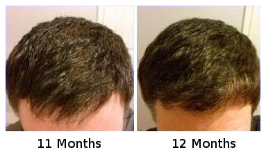 FUE Hair Transplant Before After  Hair Transplant Centre Malaysia