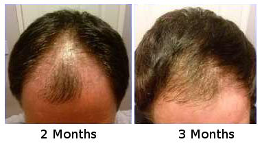 Dr Bishan Mahadevias  Hair Transplant Clinic India Hair Surgery India  Hair Doctor India  Goodbyehairloss