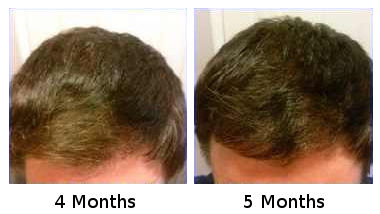 6 Month Follow Up on 2500 FUE Hair Transplant  Carolina Hair Surgery